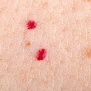 What Those Mysterious Red Dots on Your Skin Could Mean